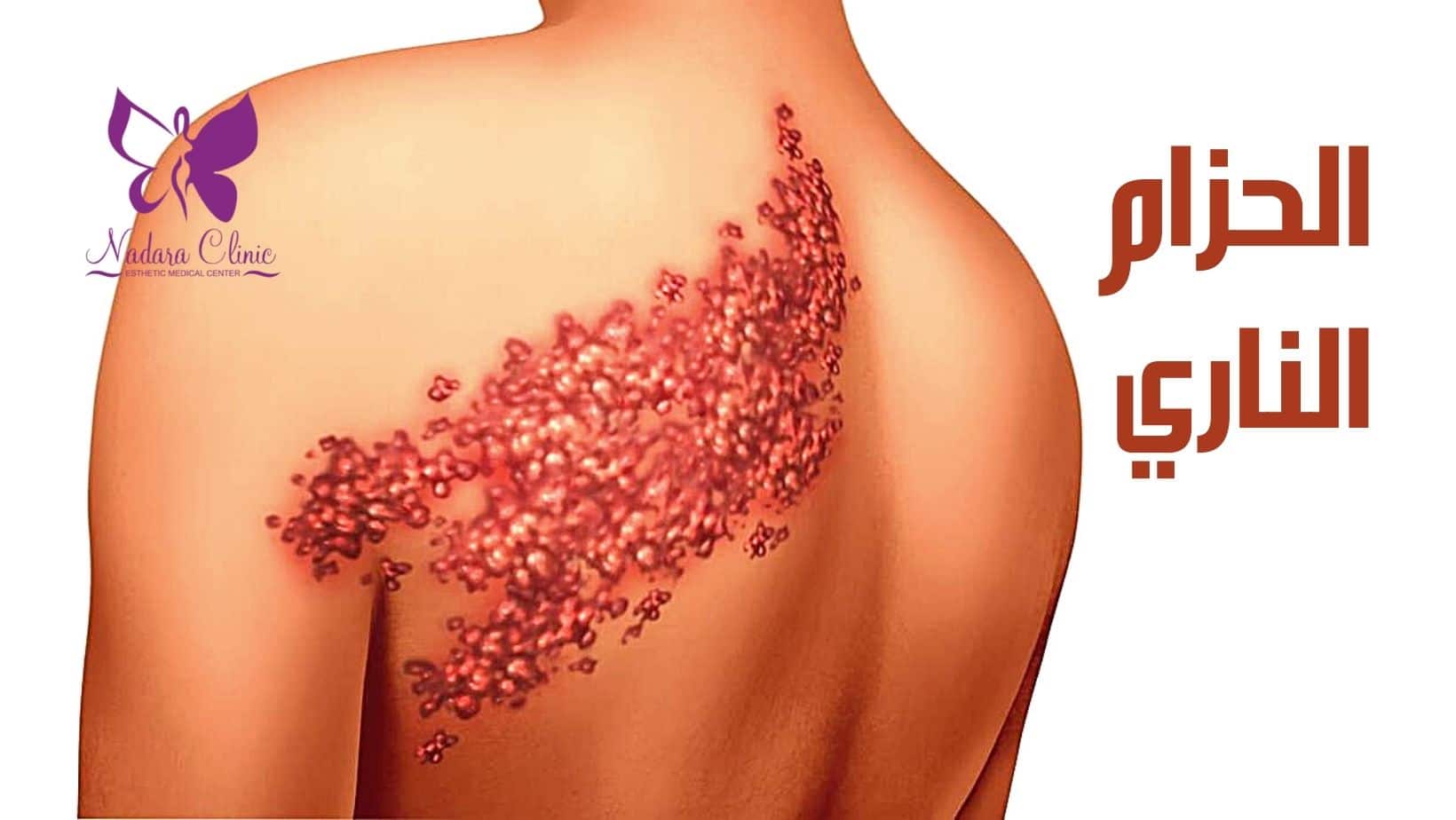 الحزام الناري